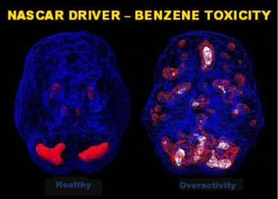 Benzene%20toxicity%208